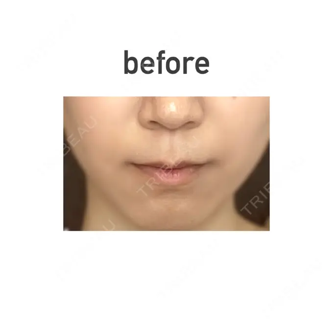 人中短縮 新宿ラクル美容外科クリニック 新宿院 BEFORE メイン用