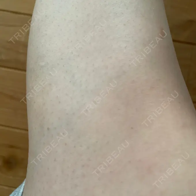 医療脱毛（全身） STARS CLINIC BEFORE メイン用