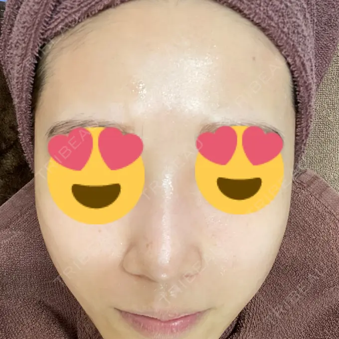 ピーリング（ニキビ・毛穴） 渋谷美容外科クリニック 渋谷院 BEFORE メイン用