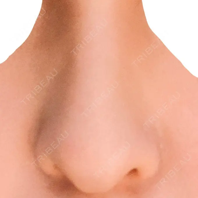 鼻中隔延長（切開） みずほクリニック BEFORE メイン用