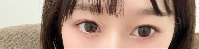 ヒアルロン酸注入（涙袋） フィラークリニック 名古屋栄院 BEFORE メイン用