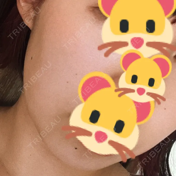 ハイフ（顔） TCB東京中央美容外科 八王子院 BEFORE メイン用