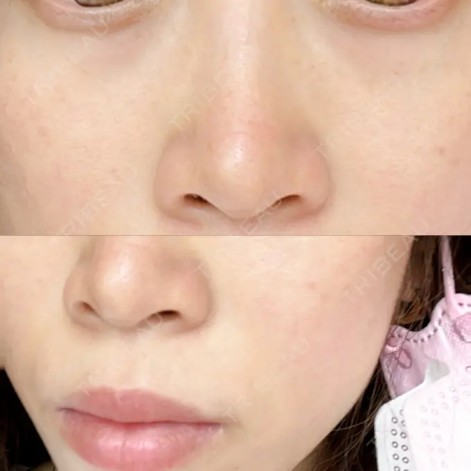 光治療（フォトフェイシャルなど） メディアージュクリニック 青山院 BEFORE メイン用