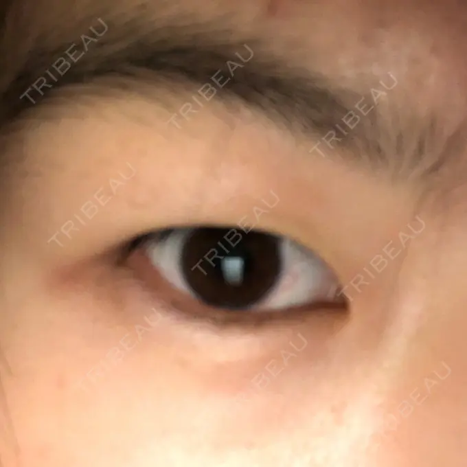 二重切開 / 上まぶたの脂肪取り ブリスクリニック形成外科・美容外科・美容皮膚科 福岡 BEFORE メイン用