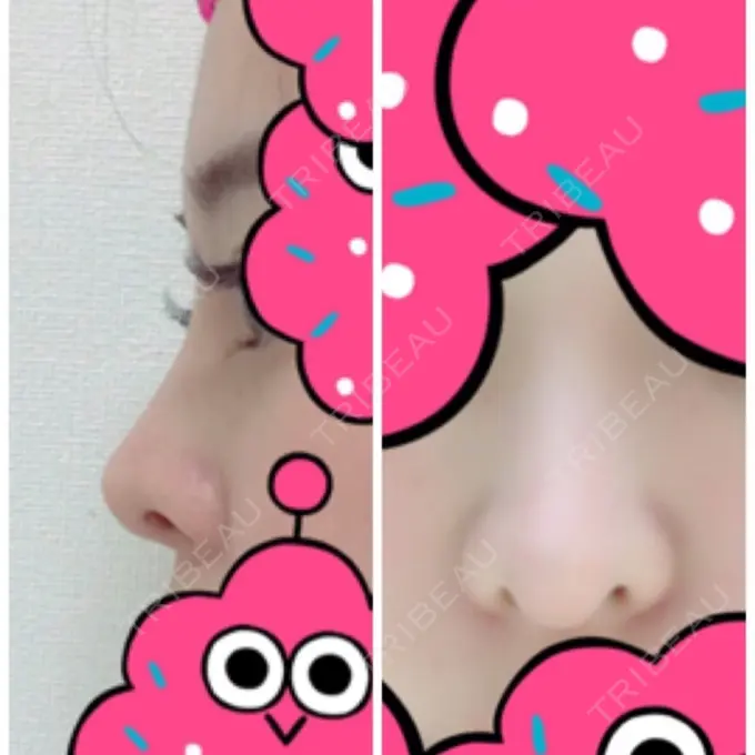 隆鼻術 / 鼻中隔延長（切開） / 軟骨移植 / 鼻修正 / 鼻孔縁下降 加藤クリニック 麻布東京院 BEFORE メイン用