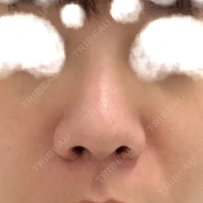 その他（鼻） TCB東京中央美容外科 八王子院 BEFORE メイン用