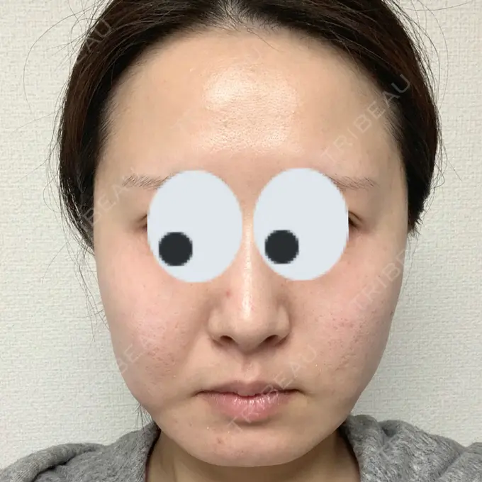 ハイフ（顔） / LED治療 Beauty Clinic the GINZA BEFORE メイン用