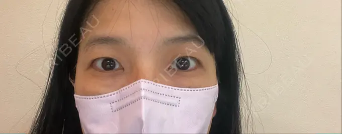 クマ治療 / 下まぶたたるみ取り セオリークリニック BEFORE メイン用