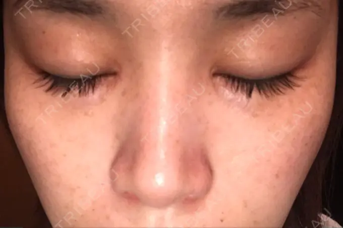 シミ取りレーザー 仁愛クリニック BEFORE メイン用