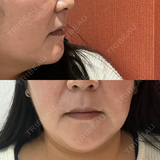 糸リフト / 脂肪吸引（顔） / 脂肪注入（額） / メーラーファット除去 / ジョールファット除去 / 脂肪注入（輪郭） / その他（輪郭） 湘南美容クリニック 秋葉原院 BEFORE メイン用