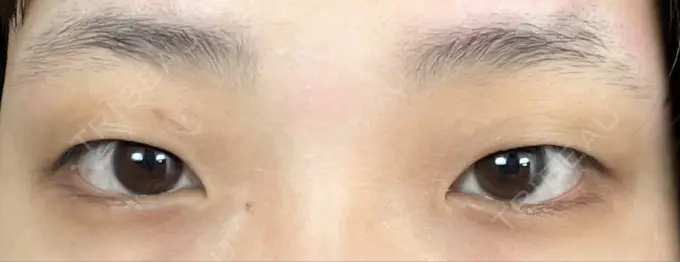 二重切開 / その他（目元） LIKI CLINIC KOBE BEFORE メイン用