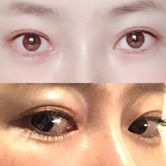 ヒアルロン酸注入（涙袋） TCB東京中央美容外科 中野院 BEFORE メイン用