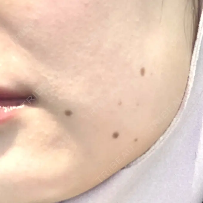 ほくろ・いぼ除去レーザー（肌） エースクリニック 大阪梅田HEPナビオ院 BEFORE メイン用