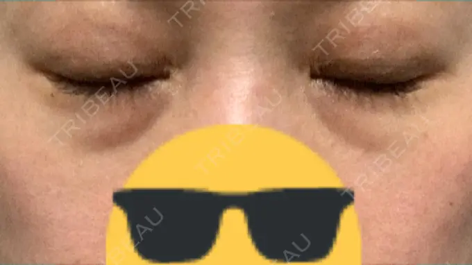 ヒアルロン酸注入（目の下） 渋谷美容外科クリニック 渋谷院 BEFORE メイン用