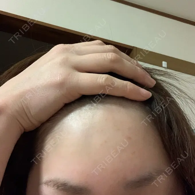 ヒアルロン酸注入（額） / ボトックス（眉間） TCB東京中央美容外科 郡山院 BEFORE メイン用