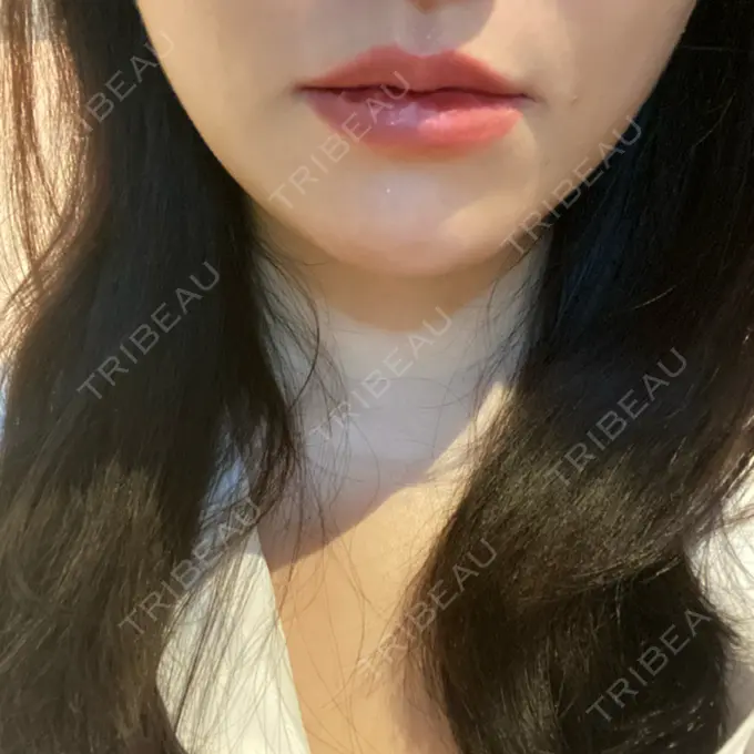 ヒアルロン酸注入（唇） / ボトックス（口角） id美容クリニック 銀座院 BEFORE メイン用