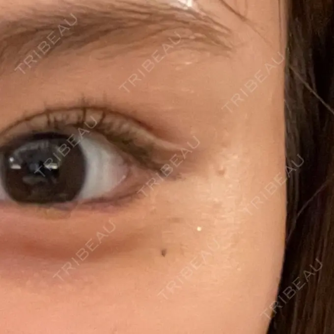 ほくろ・いぼ除去レーザー（肌） Fellez Clinic【フェルズクリニック】 BEFORE メイン用