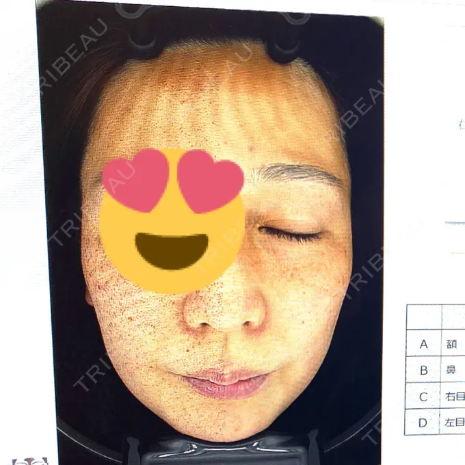 毛穴洗浄（ハイドラフェイシャルなど） SUBCLi（＆ABCクリニック） BEFORE メイン用