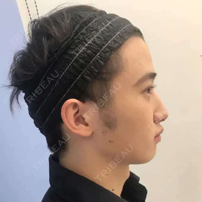 糸リフト / あごプロテーゼ 湘南美容クリニック 上野院 BEFORE メイン用