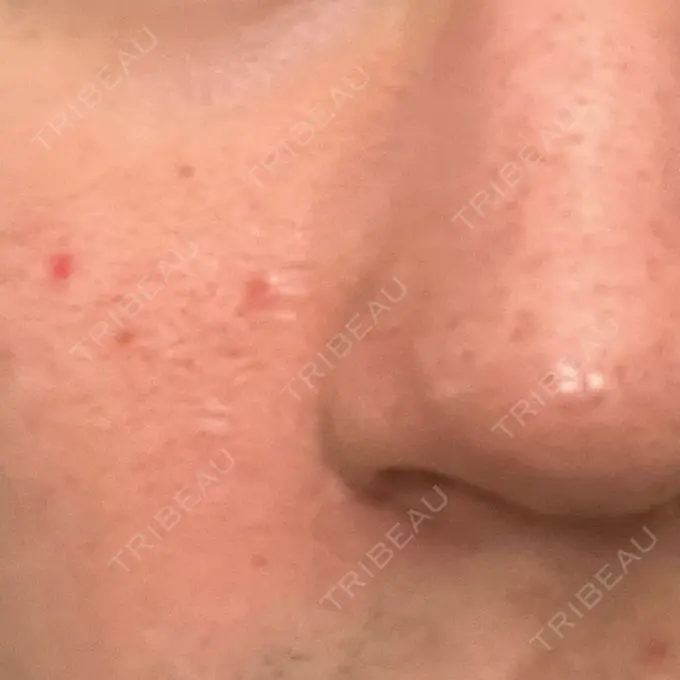 ピーリング（ニキビ・毛穴） / ダーマペン オーマイクリニック【Oh My Clinic】 BEFORE メイン用