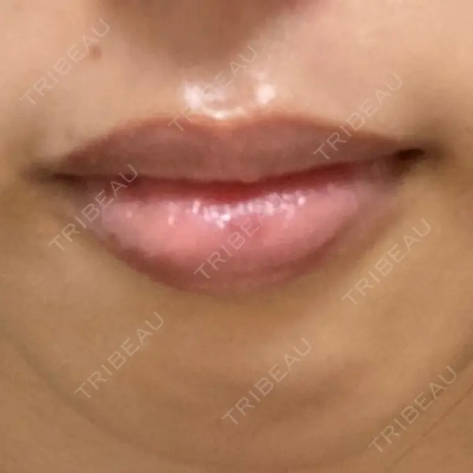 アートメイク（唇） X CLINIC 大阪院 BEFORE メイン用