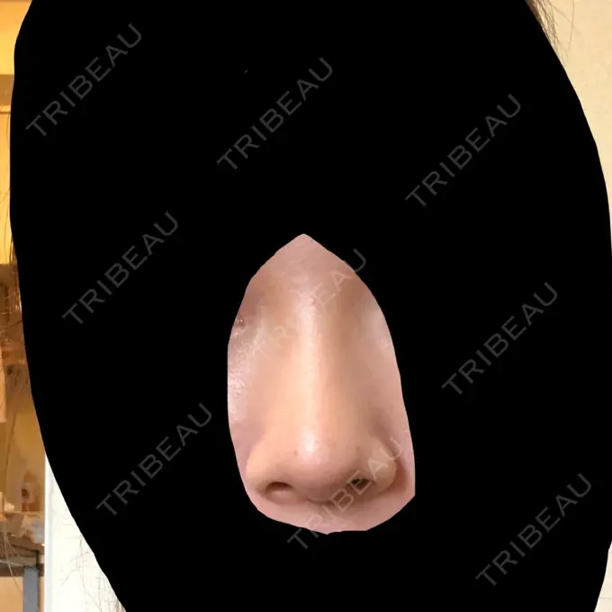 鼻尖形成（切開） / 軟骨移植 グローバルビューティークリニック 大阪院 BEFORE メイン用