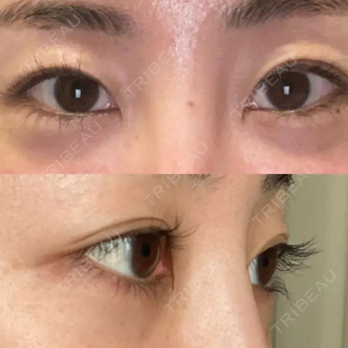 上まぶたたるみ取り e:Top clinic（イートップクリニック） BEFORE メイン用