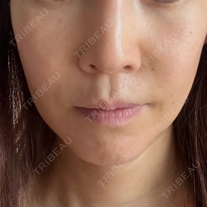 糸リフト / 脂肪吸引（顔） / ヒアルロン酸注入（額） 東京ミッドクリニック BEFORE メイン用