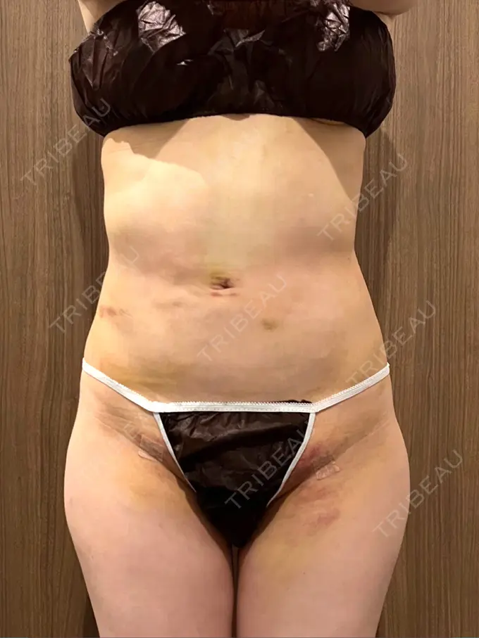 インディバ（お腹） / インディバ（腰） / インディバ（背中） WOM SALON【術後ケア取扱いサロン】 BEFORE メイン用