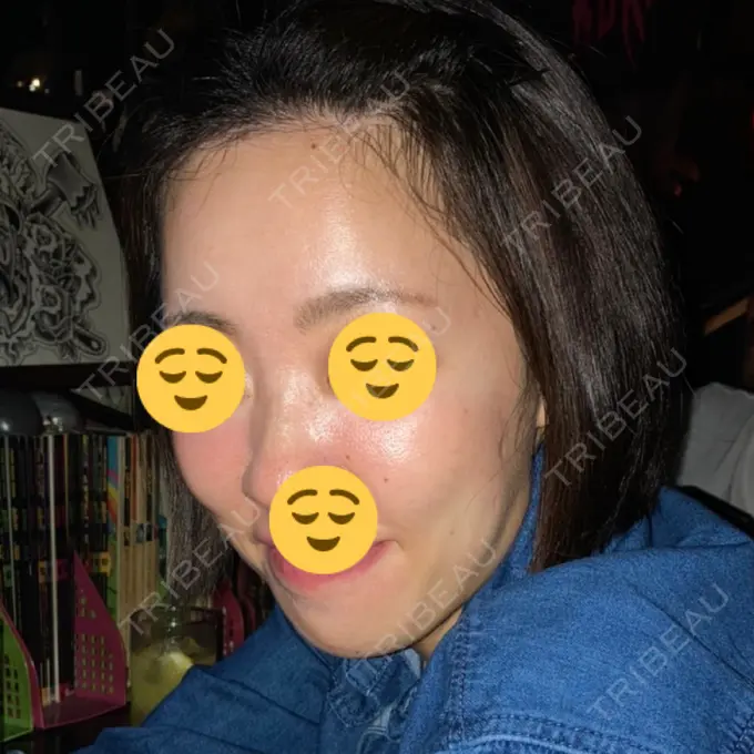 糸リフト / ボトックス（エラ・小顔） / 脂肪溶解注射（顔） X CLINIC 福岡天神院 BEFORE メイン用