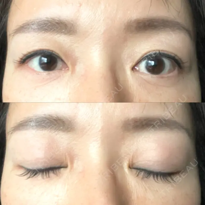 二重切開 / 眼瞼下垂（切開） / 下まぶたたるみ取り / 眉下切開 e:Top clinic（イートップクリニック） BEFORE メイン用