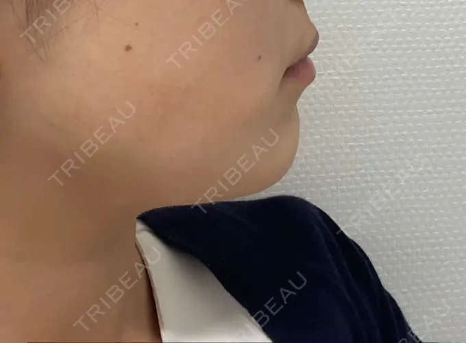 ボトックス（エラ・小顔） ルラ美容クリニック 大阪本院 BEFORE メイン用