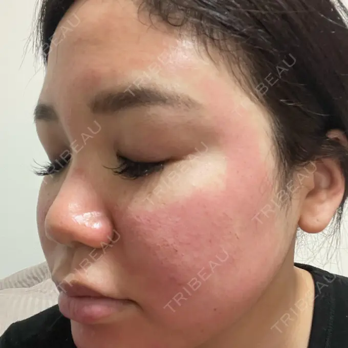 美容点滴・美容注射（美肌） / ヴェルヴェットスキン オーマイクリニック【Oh My Clinic】 BEFORE メイン用