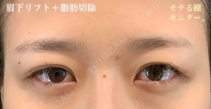 上まぶたの脂肪取り / 眉下切開 e:Top clinic（イートップクリニック） BEFORE メイン用
