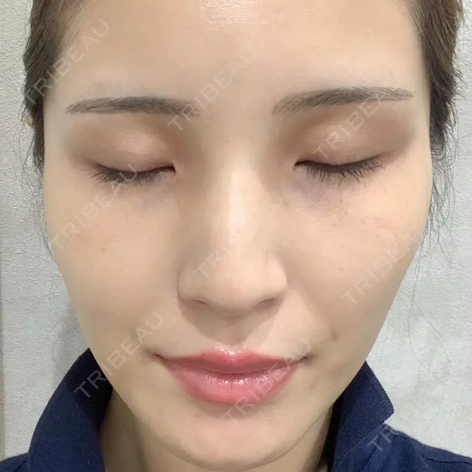 人中短縮 / ヒアルロン酸注入（唇） / ボトックス（口角） EMMO FACE CLINIC 大宮院 BEFORE メイン用