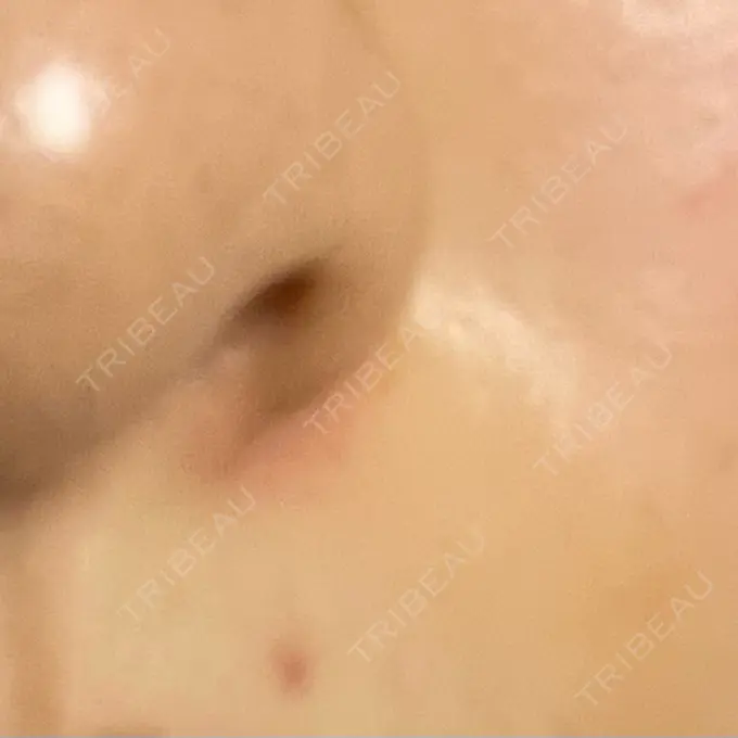 シミ取りレーザー 聖心美容クリニック 名古屋院 BEFORE メイン用