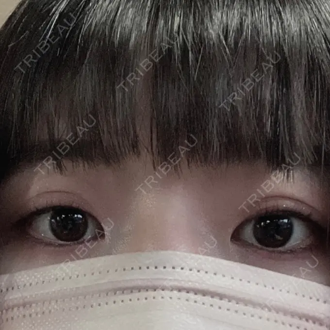目頭切開 TCB東京中央美容外科 岡山院 BEFORE メイン用