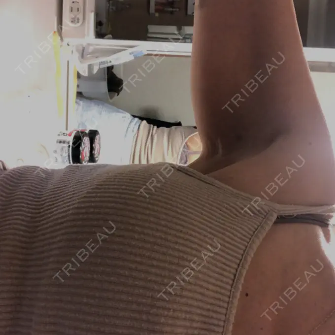 脂肪溶解注射（二の腕） ルラ美容クリニック 千葉院 / ルラスキンクリニック 千葉院 BEFORE メイン用