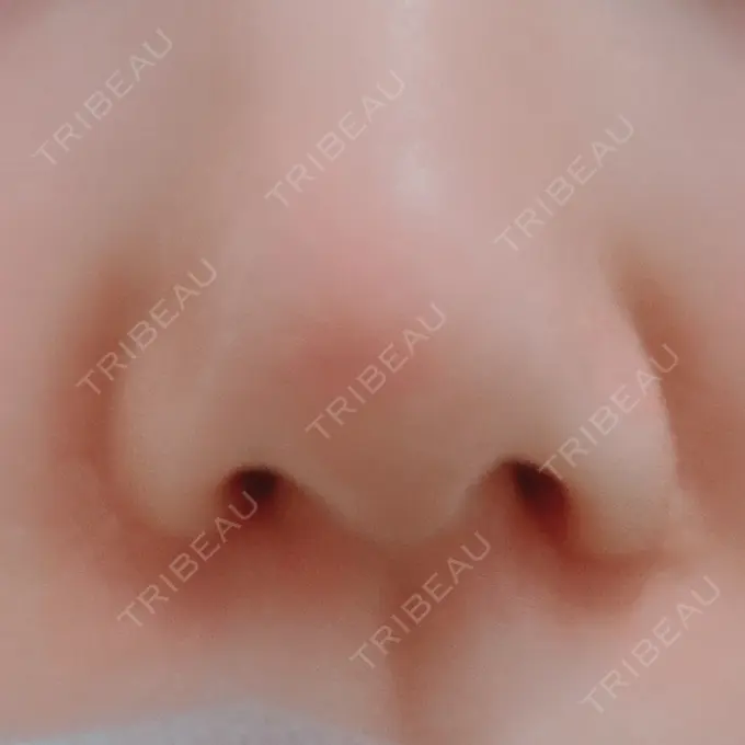 鼻孔縁挙上 シエルクリニック BEFORE メイン用