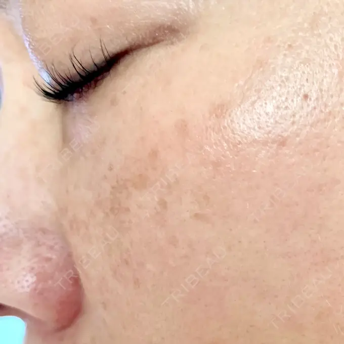 毛穴洗浄（ハイドラフェイシャルなど） / 光治療（フォトフェイシャルなど） 東京素肌クリニック 銀座本院 BEFORE メイン用