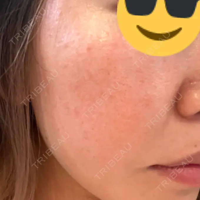 レーザートーニング（美白・肝斑） シェリークリニック 新宿本院 BEFORE メイン用