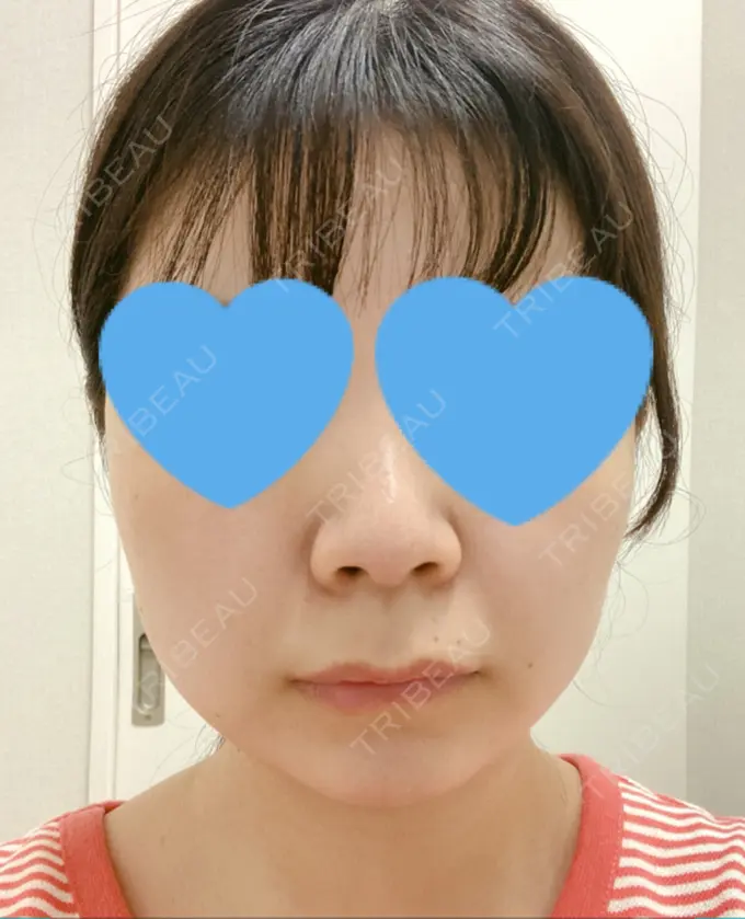 目頭切開 / 小鼻縮小（切開） / バッカルファット除去 / 脂肪吸引（顔） / 人中短縮 / ボトックス（ガミースマイル） / その他（鼻） / その他（口元） ルラ美容クリニック 名古屋本院 BEFORE メイン用