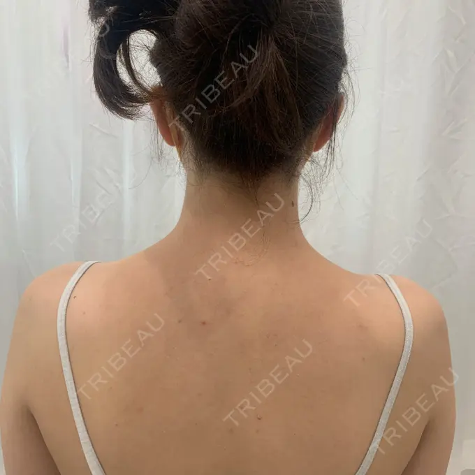 ボトックス（肩） APスキンクリニック銀座 BEFORE メイン用