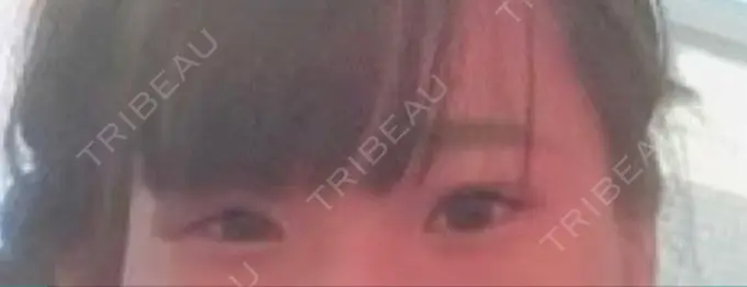 二重切開 / 目頭切開 / 上まぶたの脂肪取り MIL CLINIC OSAKA BEFORE メイン用