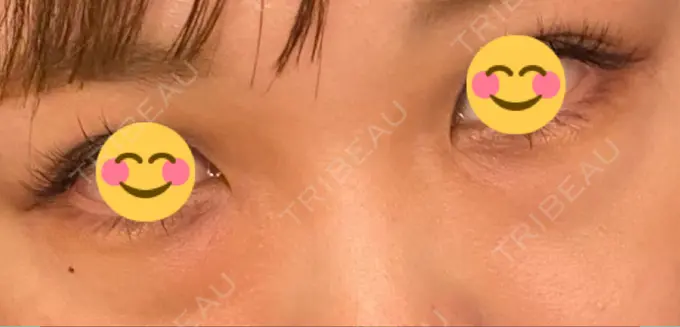 下まぶたの脂肪取り 吉井クリニック BEFORE メイン用