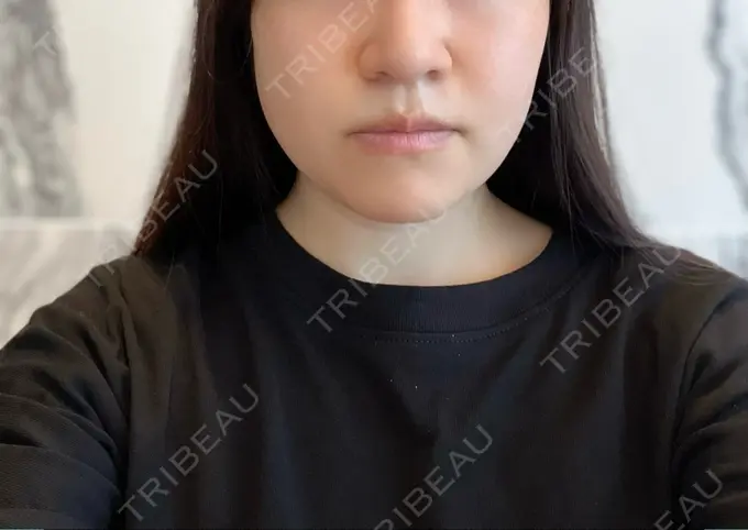 脂肪吸引（顔） THE CLINIC（ザ・クリニック） 福岡院 BEFORE メイン用