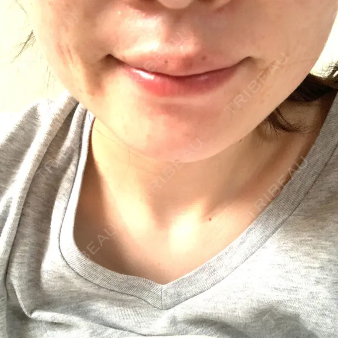 肌ヒアルロン酸注入（たるみ・シワ改善） / その他（鼻） TCB東京中央美容外科 郡山院 BEFORE メイン用