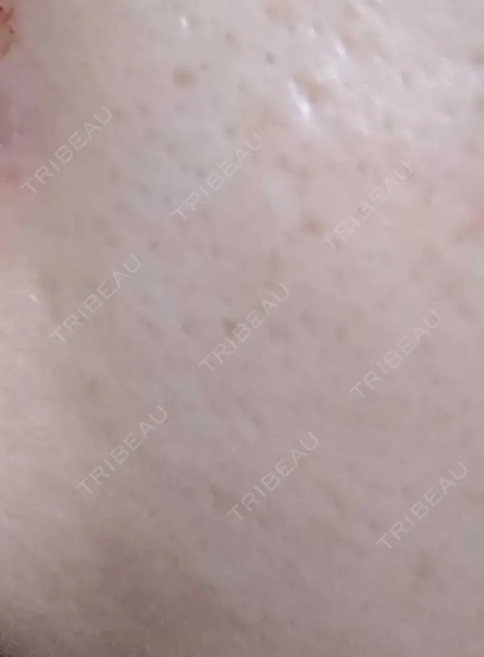 エレクトロポレーション 品川スキンクリニック大宮院 BEFORE メイン用