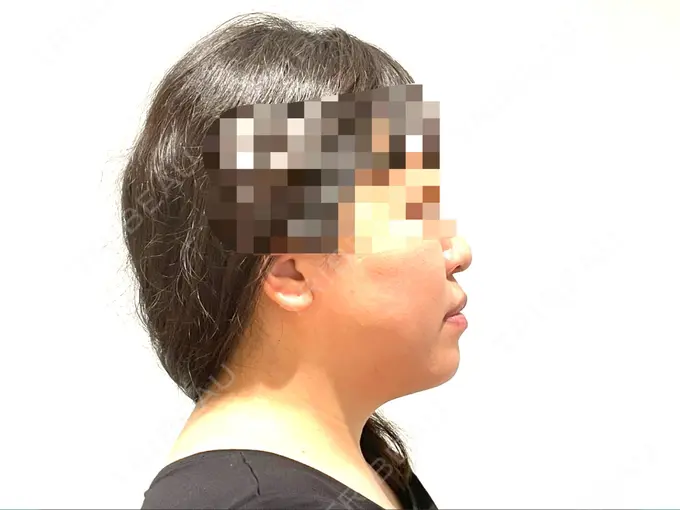 骨切り（あご） / セットバック カトレア歯科・美容クリニック BEFORE メイン用