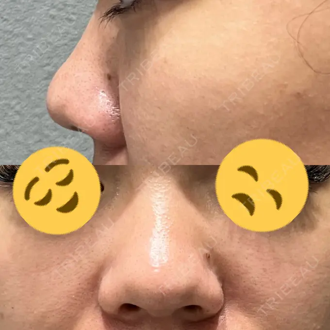 鼻中隔延長（切開） / 眉間プロテーゼ / 鼻尖縮小 / 鼻尖形成（非切開） YBC横浜美容外科 大宮院 BEFORE メイン用